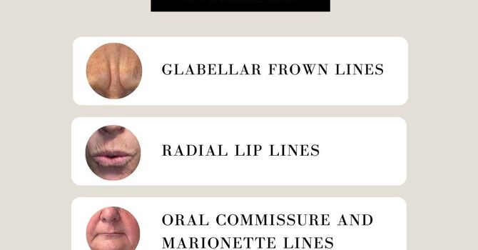 Solid Filler Smooth PDO Threads